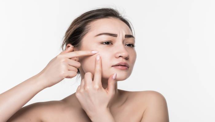 Cara Mudah Memudarkan Bekas Jerawat